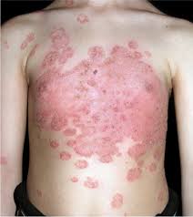 Sep 01, 2016 · pityriasis versicolor is a superficial skin infection caused by four of the eleven species of malassezia (malassezia furfur, malassezia sympodialis, malassezia globular and malassezia obtusa), characterized by changes in skin pigmentation, with irregular and well demarcated patches and may be related to pregnancy, disease like diabetes, state. Kommt Der Pilz Vom Haustier Springerlink
