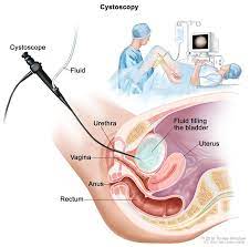 Most people will notice blood in the urine or maybe some bladder cancer: Cancerhelp Online Nci Cancer Diagnosis And Treatment