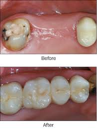Klinik pergigian kajang is a klinik kerajaan pergigian in kajang, selangor that provides you great dental care at harga rawatan untuk prekhidmatan klinik pergigian kerajaan tertentu: Gigi Palsu Di Klinik Kerajaan