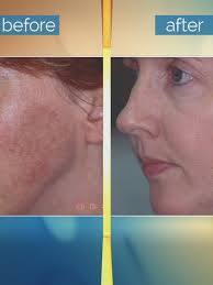Why is there a need for trained and trusted experts in the aesthetic arena? Aesthetic Medicine Help For Sun Damaged Skin Katu