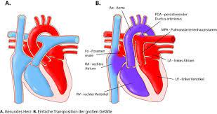 Low voltage safety compliance low voltage safety compliance has been evaluated by tuv rheinland of north america, inc. Transposition Der Grossen Gefasse Ukm Klinik Fur Herz Und Thoraxchirurgie