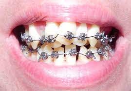 There's a dangerous trend going around of teenagers applying diy (do it yourself) braces to their own teeth as a means of fixing them!check us out on. Risks Of Do It Yourself Braces At Homedr Jacquie