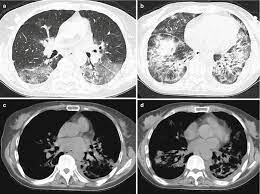 Legionella pneumophila is a gram negative, strictly aerobic bacterium of the. Legionnaires Disease Radiology Key