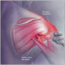 Pin On Shoulder Injury
