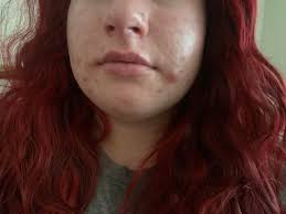 Seeking help pleaseeeee😭🙏🏼🙏🏼 I never had acne like this or in these  areas before. Started 2 months ago and won't go away Tried -starting smoo  powder -reducing dairy refined sugars and fried