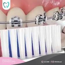 Promosi hot di mens braces: Premier Dental Orthodontic Centre Home Facebook