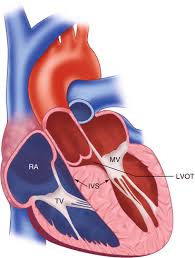 Image result for Left Ventricular Outflow Obstruction