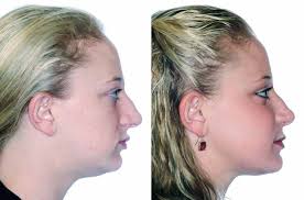 Corrective Jaw Surgery Corrective Jaw Or Orthognathic Surgery Is Performed By An Oral And Maxillofaci Cosmetic Dentistry Jaw Surgery Corrective Jaw Surgery