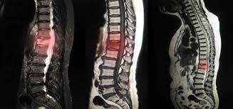 Clinica herniei de disc cervicale cu pozitie mediana: Hernia De Disc Cervicala Cauze Simptome Si Cum Tratezi Aceasta Afectiune Periculoasa