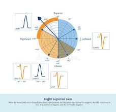 Image result for Right Axis Deviation