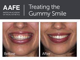 Although very unlikely, it's possible for how you prepare. Gummy Smiles Are Successfully Treated With Botox When Performed By Expert Injectors Gummy Smile Botox Gummy Smile Facial Esthetics