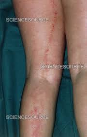 Image result for Hookworm