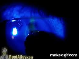 Image result for Seidel Test