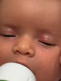 What could be causing cloudy and red eyes in baby goats and how to treat it?