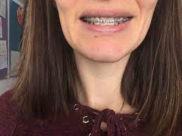 Pin On Braces