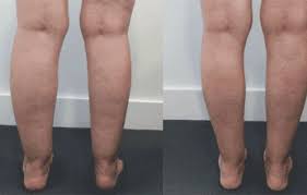 Ankle And Calf Liposuction Before And After Images Palm Clinic