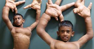 Check spelling or type a new query. Boy With Giant Hands Gets Pioneering Surgery After Being Dubbed The Devil And Excluded From School Mirror Online