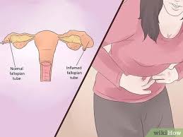 Check spelling or type a new query. 3 Ways To Treat Blocked Fallopian Tubes Wikihow