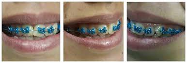 10 Colored Blue Braces For Adults And Kids Braces Explained