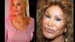 10 Celebrity Before And After Plastic Surgery Disasters Celebrity Plastic Surgery Celebrities Plastic Surgery
