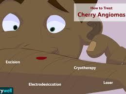 Cherry angiomas are a common cutaneous vascular proliferation which manifests as single or multiple spots and occurs predominantly on the upper trunk and arms. Cherry Angioma Symptoms Causes Diagnosis Treatment