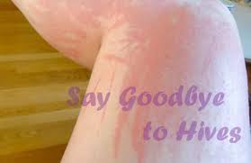 Typically, your symptoms of hives should disappear within 24 hours from the first hour it manifested on your skin. How To S Wiki 88 How To Get Rid Of Hives On Face Quickly