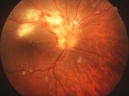 Image result for HIV Retinitis