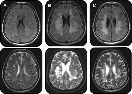 A demyelinating disease is a disease characterized by damage to the myelin sheaths which cover in a sense, a demyelinating disease strips the body's wiring of its insulation, and just as a house's. Teaching Neuroimages Brucellosis Mimicking Demyelinating Disease Neurology