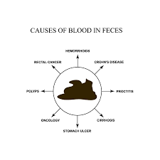 Image result for Blood in stool
