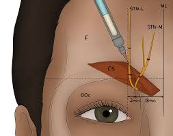 Image result for Botulinum Toxin Injection