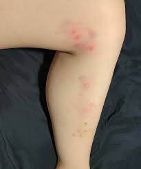 Its tunnels can sometimes be visible on the surface of the skin, where. Very Itchy Bumps That Look Like Mosquito Bites Currently All On One Side Of The Leg They Don T Have Red Dots In The Centres Show Up In 1s And 3s During The
