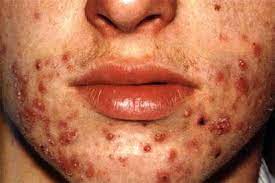 El Acne Perjudica Gravemente La Autoestima Salud El Pais