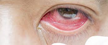 Résultat de recherche d'images pour "eye infection"