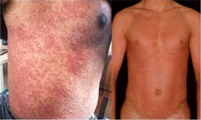 Image result for skin rash acute hiv infection