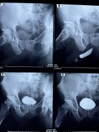 Image result for Voiding Cystourethrogram