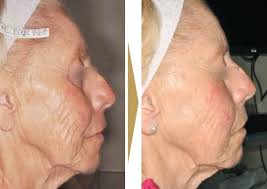 Accessible in multiple models to accommodate all your requirements. Anti Aging Fractional Laser Plastische Chirurgie Zentrum Fur Asthetische Medizin Wien
