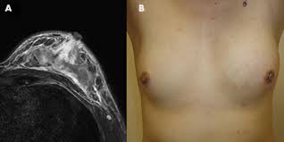 Breast infections can cause redness and swelling. Evaluation Of Breast Edema Findings At T2 Weighted Breast Mri Is Useful For Diagnosing Occult Inflammatory Breast Cancer And Can Predict Prognosis After Neoadjuvant Chemotherapy Radiology