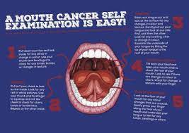 Tongue cancer is a type of cancer that starts in the cells of the tongue, and can cause lesions or tumors on your tongue. Nhs Greater Glasgow And Clyde Lets Talk About Mouth Cancer Easy Self Exam Remember Visit Your Dentist Regularly To Have A Professional Exam Couldbeurmouth Nhsggc Mouthcanceraction Facebook