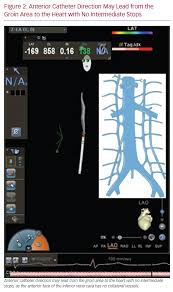 The pubic bone divides the groin area and separates it from the abdominal area. Anterior Catheter Direction May Lead From The Groin Area Aer Journal