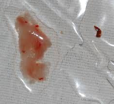 Hemoptisis - Wikipedia, la enciclopedia libre