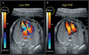 Color flow doppler is the primary method to evaluating the presence of regurgitation. Color Doppler In Fetal Echocardiography Obgyn Key