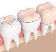 What Type of Materials Are Used in Dental Restorations?