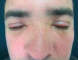 Jun 06, 2021 · a ploeren, près de vannes, (morbihan), un homme est décédé dans la nuit de samedi à dimanche. Scielo Brasil Syndrome In Question Syndrome In Question