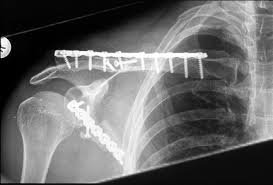 Durch den codman griff wird bei der bewegungsprüfung der schulter der einfluss der schulterblattbeweglichkeit minimiert. Https Edoc Ub Uni Muenchen De 2981 1 Schmid Kristina Pdf