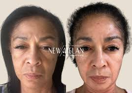 ✨ ¡Dile adiós al melasma con NewMelan del Dr. Eduardo Krulig! ✨ ¿Las  manchas afectan tu piel y tu confianza? Con NewMelan del Dr. Eduardo  Krulig, recupera la belleza natural de tu