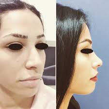 13 opiniones de Rinoplastia Integral (Cirujano plástico) en San Isidro  (Lima)