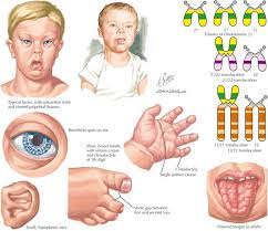 Trisomy 21 Obgyn Key
