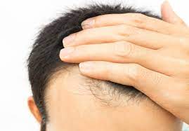 However, according to estimates, an intake of 30 micrograms (mcg) Biotin For Hair Growth Dosage And Side Effects