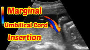 Marginal cord insertion is a mistreated potential risk for low birth weight, preterm birth, and emergency cesarean delivery. Marginal Umbilical Cord Insertion Youtube