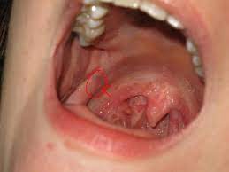 I'm especially interested in symptoms of breast cancer, when the lump can be palpitated, does it use to be hard or soft? Soft Palate Cancer United States Pdf Ppt Case Reports Symptoms Treatment